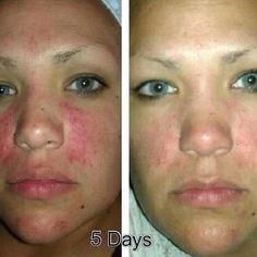NeriumAD Age-Defying Treatment! Before and After Pictures! #Nerium