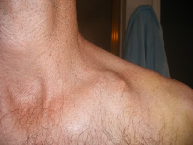 clavicle comminuted broken mark dr fracture presence midshaft findings clavicular