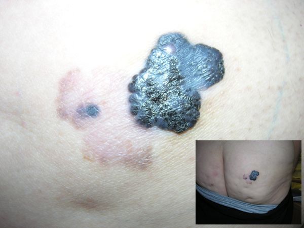 photo melanomabottom_zps36d4db3b.jpg