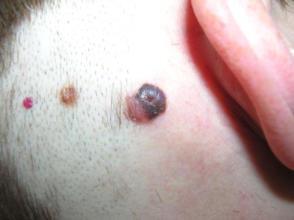 photo melanomauho_zps4ad584ef.jpg